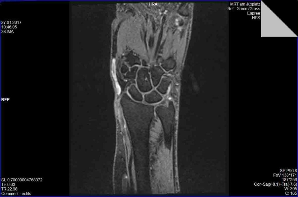 Tendovaginitis stenosans de Quervain Praxis für Orthopädie und Unfallchirurgie